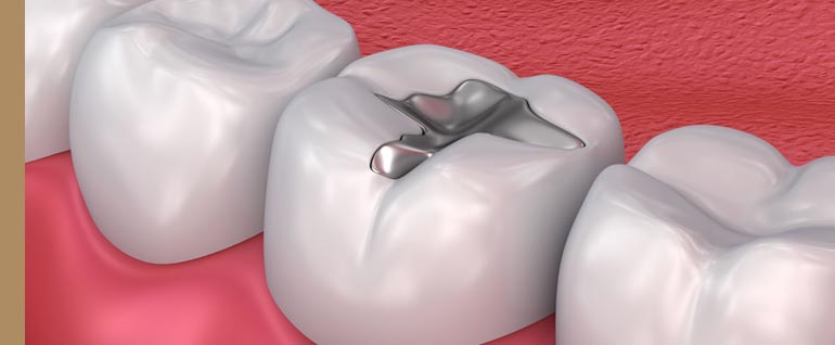 tooth aligner treatment in bandra west